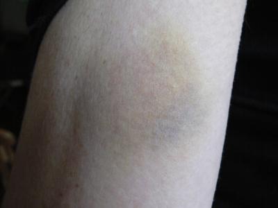 blauwe arm